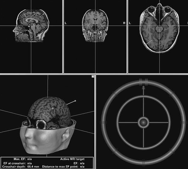 Magnetstimulatiooni sihtmärgid ajukoores. 